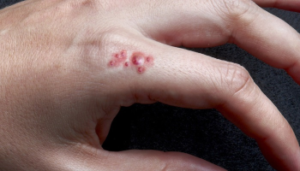 استافیلوکوکوس اورئوس چیست؟