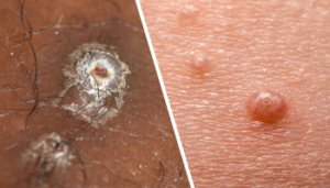 مولوسکوم کنتاژیوزوم؛ علایم و راه های درمان