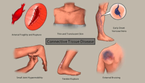 بیماری بافت همبند چیست؟